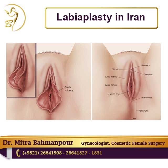 Labiaplasty in Iran