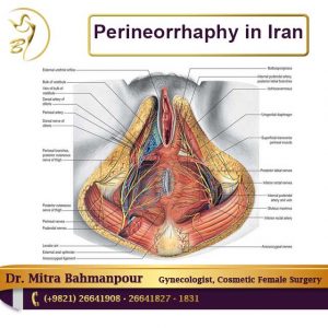 Perineorrhaphy in Iran