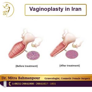 Vaginoplasty in Iran