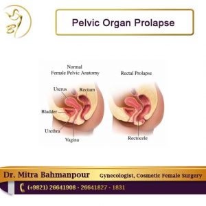 pelvic organ prolapse