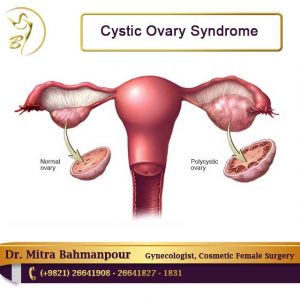 cystic ovary syndrome