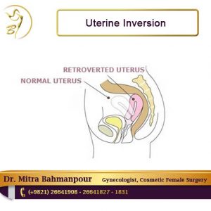 uterine inversion