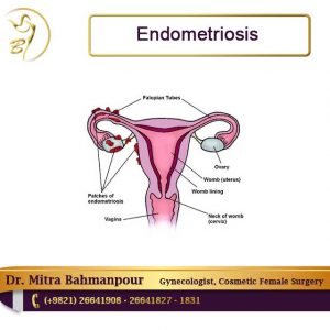 endometriosis