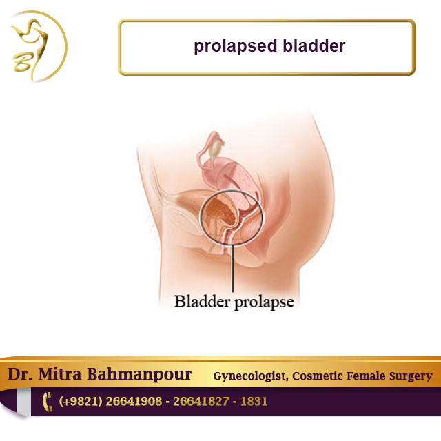 Prolapsed Bladder Surgery