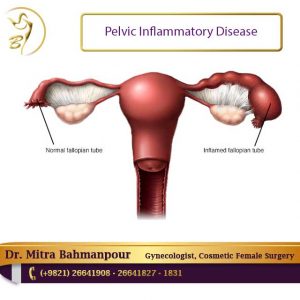 pelvic inflammatory diseases