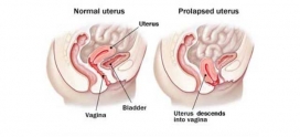 uterine prolapse