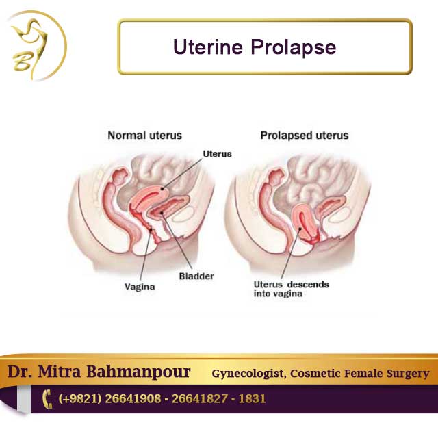 uterine prolapse, prolapsed uterus