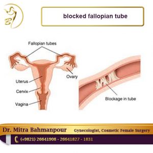 blocked fallopian tube