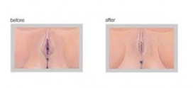 Laser reduction labiaplasty