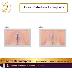 laser reduction labiaplasty